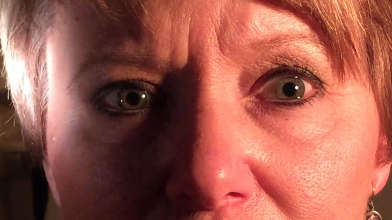 Colles fracture orthopedics ,fractures all about mcq detail note 