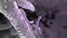 Moon Face, Buffalo Hump AND Purple Striae: Classic Signs of Cushing Syndrome Explained